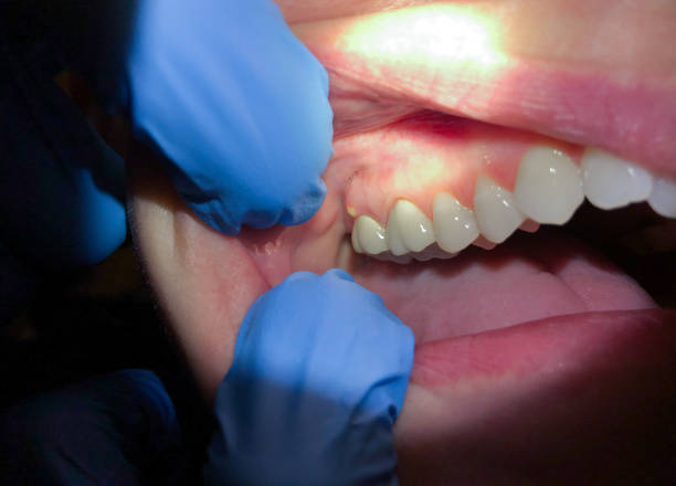 Best Broken or Cracked Tooth Emergency Dentist in Layton, UT